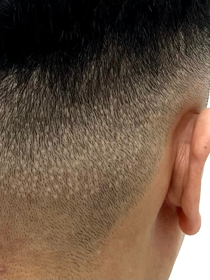 I covered my scalp tattoo and hair transplant scars in Daegu. It's so refreshing