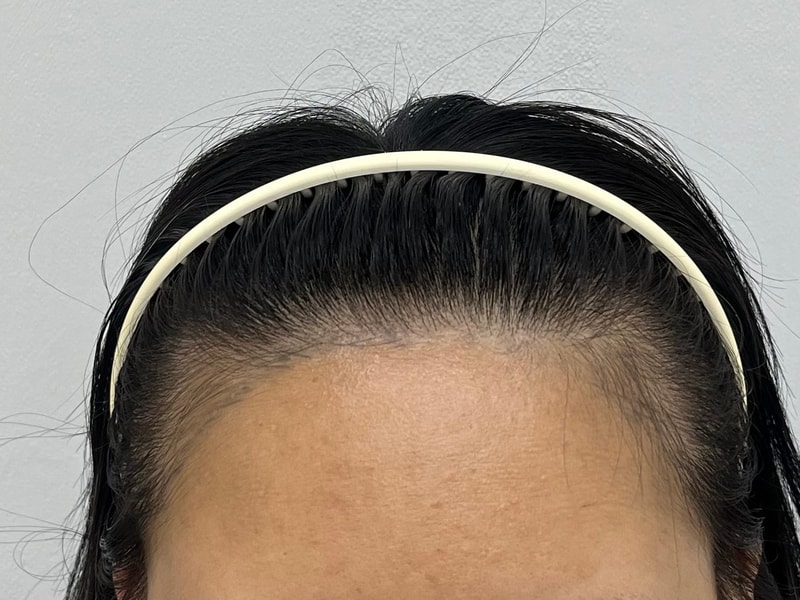 大邱でヘアラインが崩れたのを 苦労して修復