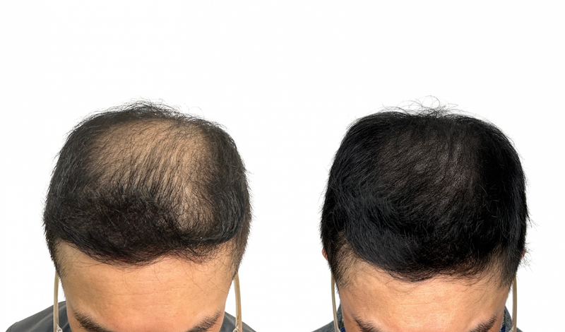 결국 남편까지 두피문신을....