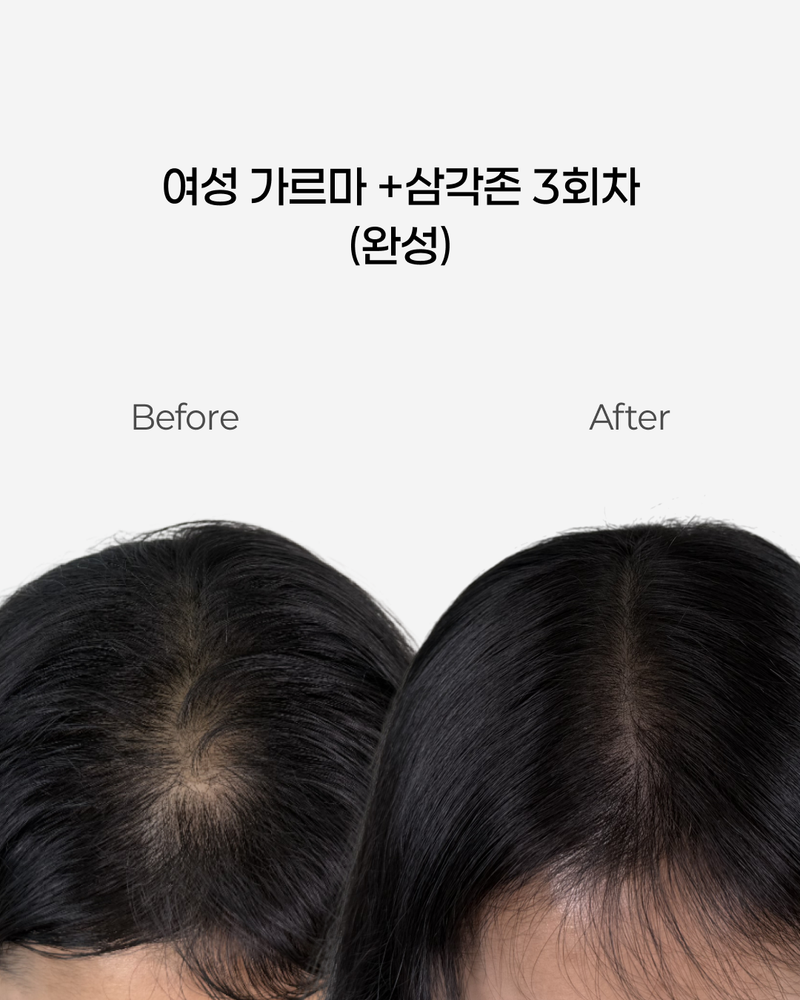 두피문신/색소요법