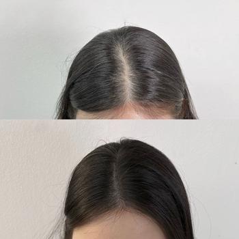 원장님이 보내주셨던 시술 전 후 사진입니다