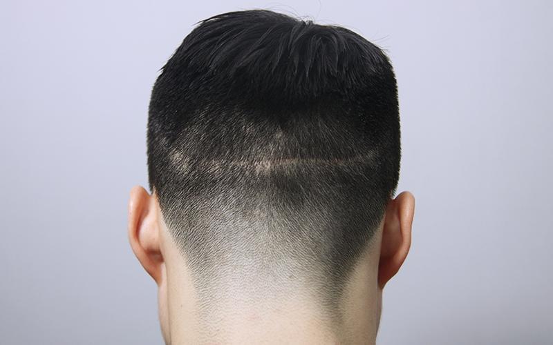 切开疤痕！用头皮纹身遮盖！