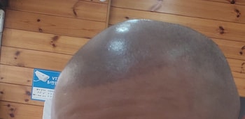 (2차 시술 직후)