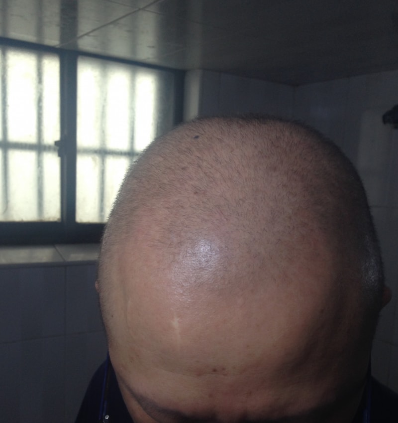 두피문신 이제 해볼까 싶네요