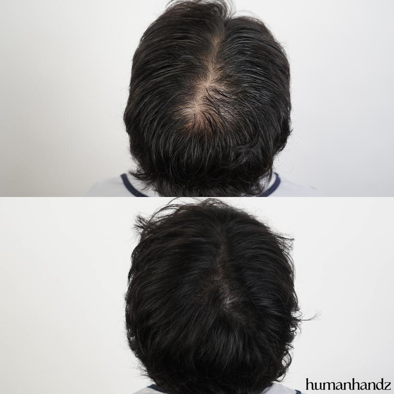 头皮纹身1年的我很满意。