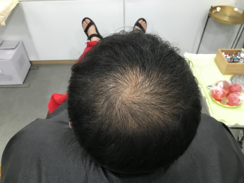 [연세미다인]두피문신 후기올립니당