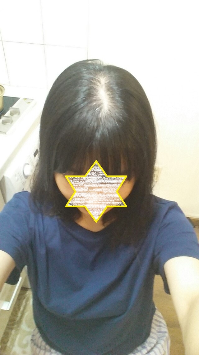 다나성형외과에서 두피문신 시술 받고왔어요~!