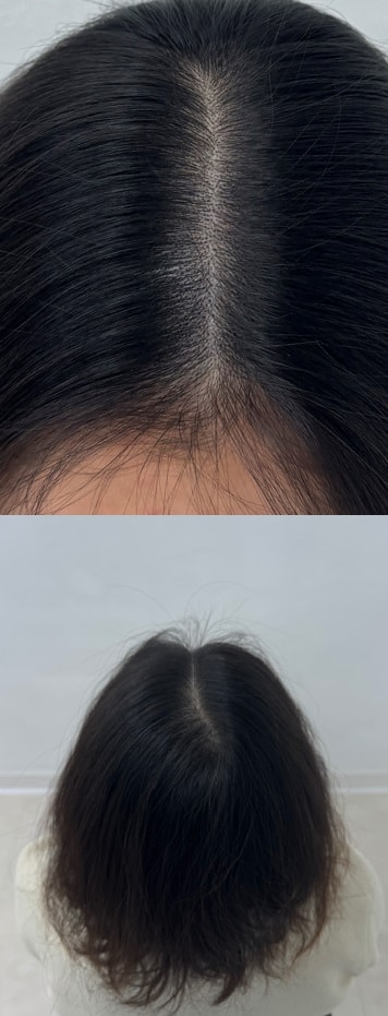 두피문신 받은 후