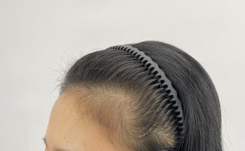 이건 시술받을때 찍은 비포사진이에요