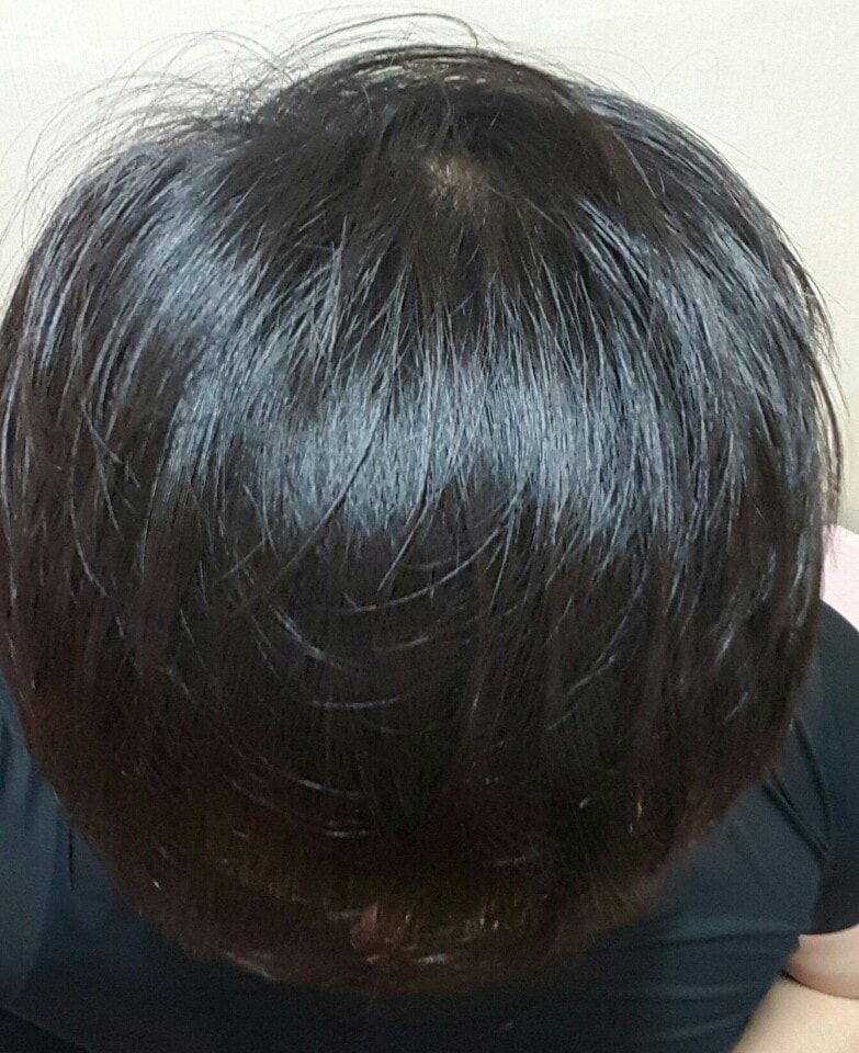 20대 후반 남자.. 두피문신 효과 있을까요??