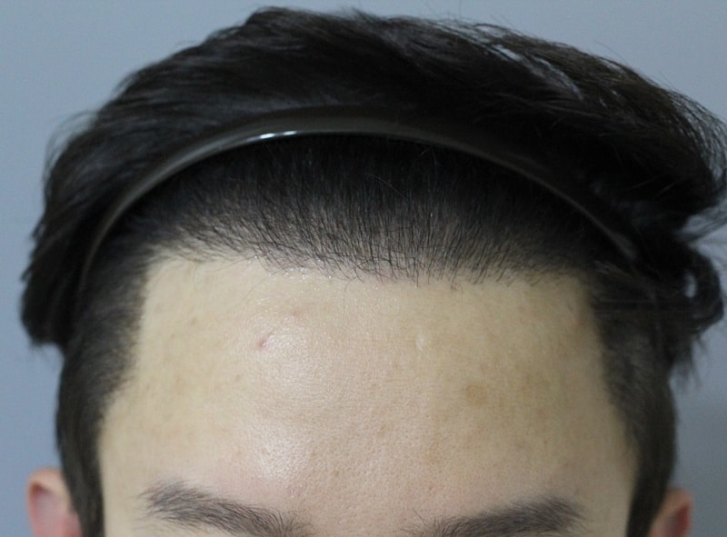 두피문신 후기 (헤어라인, 비절개 흉터)