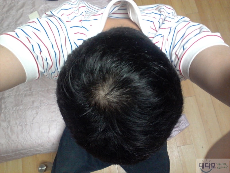 마이녹실과 아보다트 효과 .... .