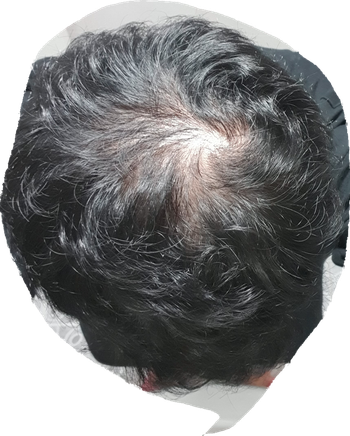 정수리 탈모