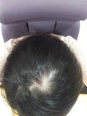 뉴헤어에서 정수리두피문신smp 받고 일주일