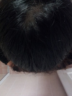 뉴헤어 두피문신하고 2주