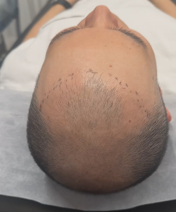 LSMP기법시술사례