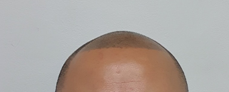 두피사진_1