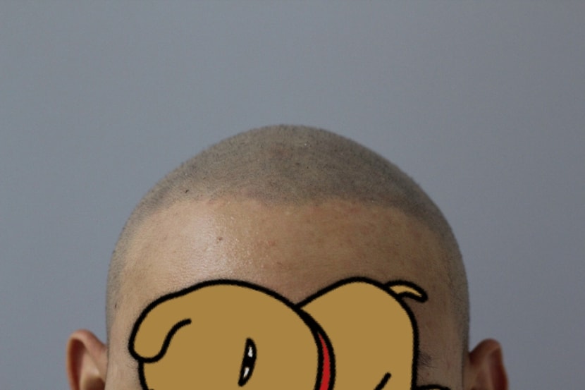 시술후