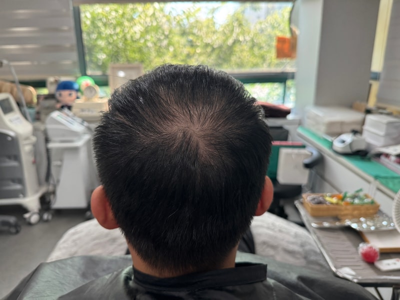 是头皮纹身后记。