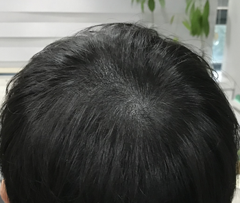 두피문신 후 사진입니다.