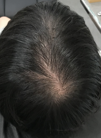 두피문신 전 사진입니다.