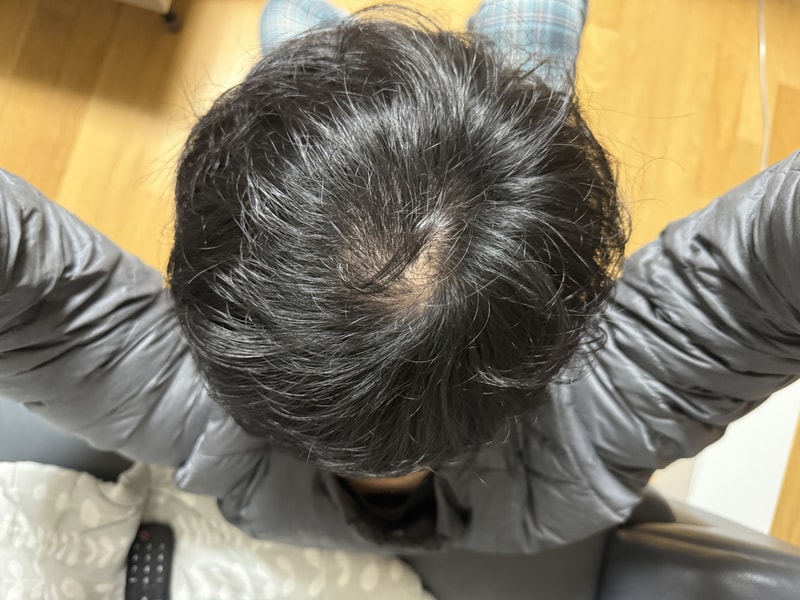 정수리 두피문식 견적 및 관리 문의