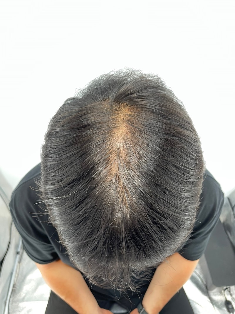 강남 뉴헤어 두피문신