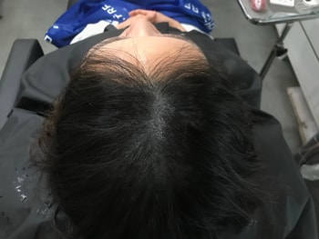 두피문신후