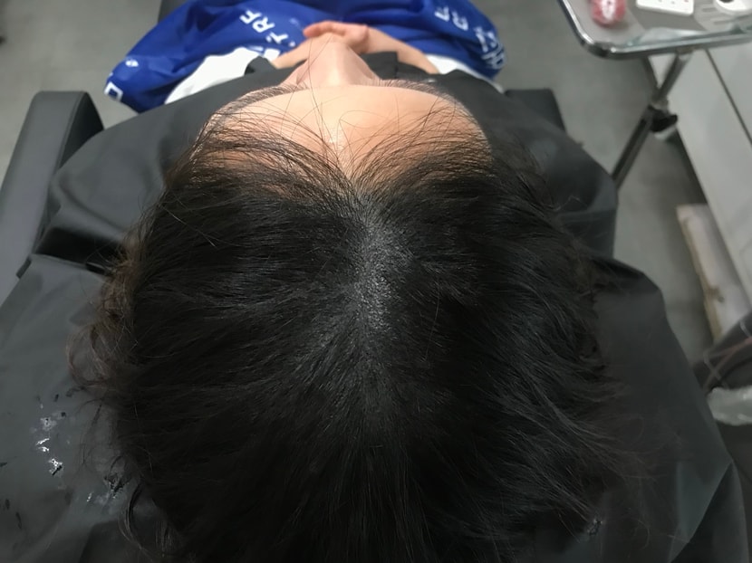 두피문신후