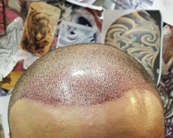 4th procedure of scalp tattoo