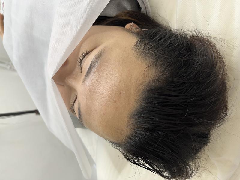 M자이마는 이마축소말고 반영구하세요