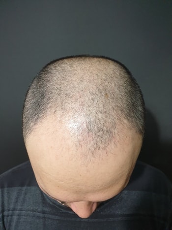 문신하기전  3mm 자른후
