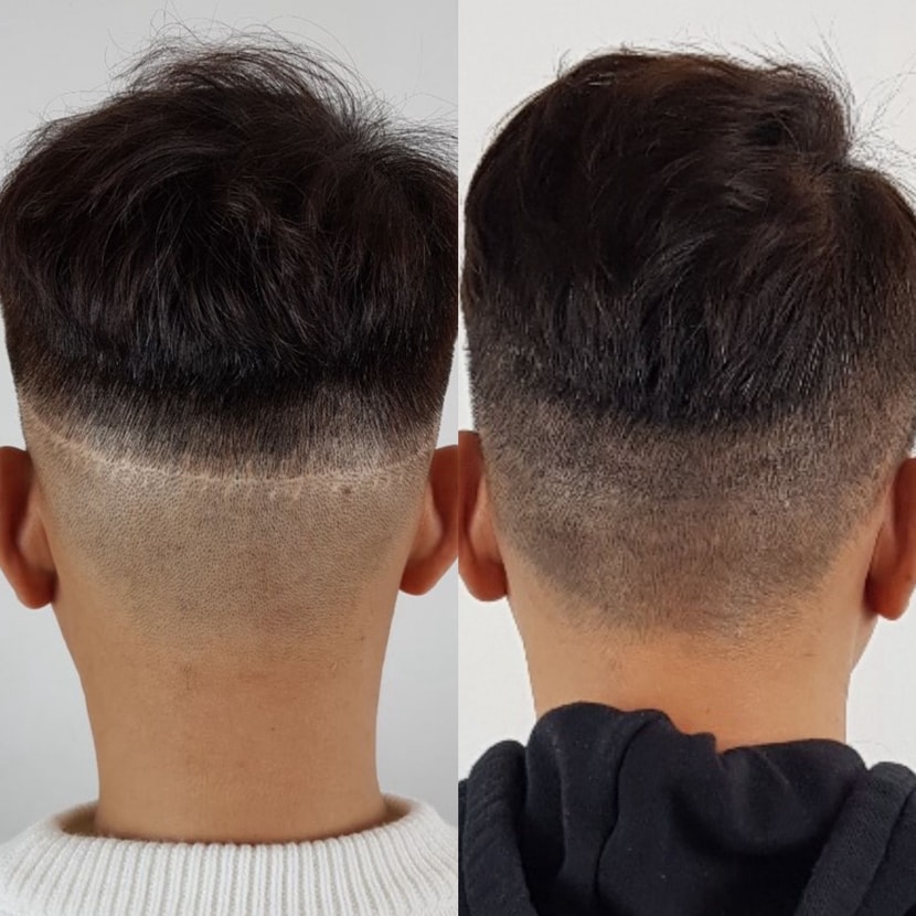 절개 흉터커버