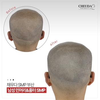 민머리 & 흉터커버 시술
