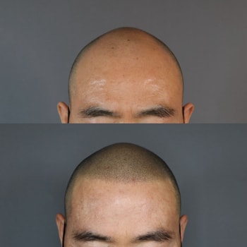 남자 삭발시술