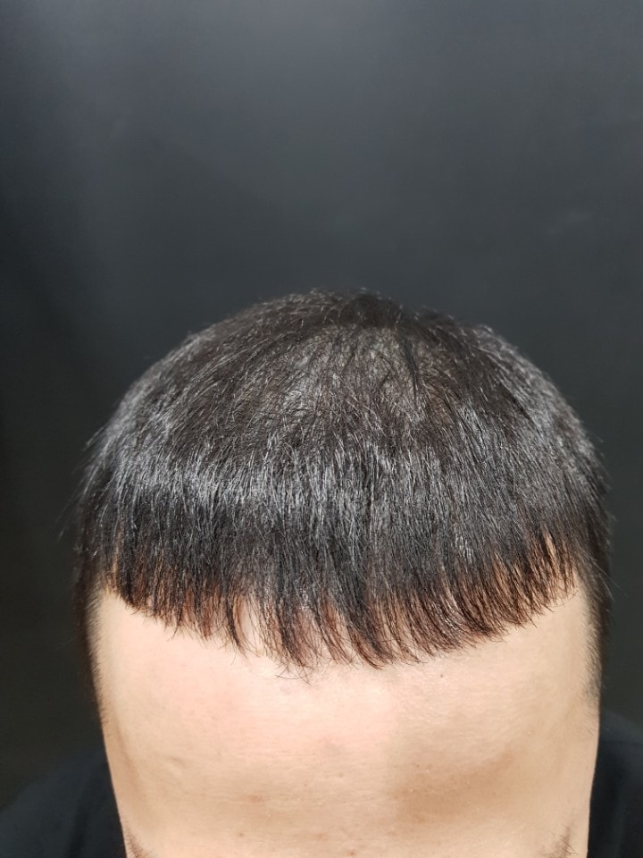 두피문신 2차 후기 올립니다!! (10년전 모발이식부터 두피문신까지)