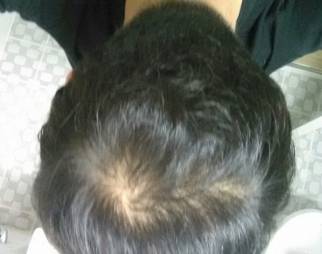 이정도면 두피문신 해도 괜찮을까요?