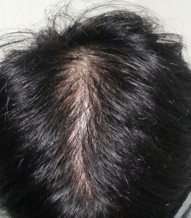 고민끝에 두피문신 받았습니다