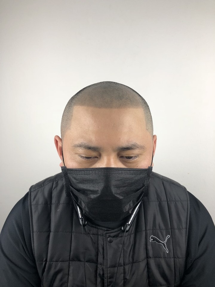 두피 문신 실패 후 2차 수정