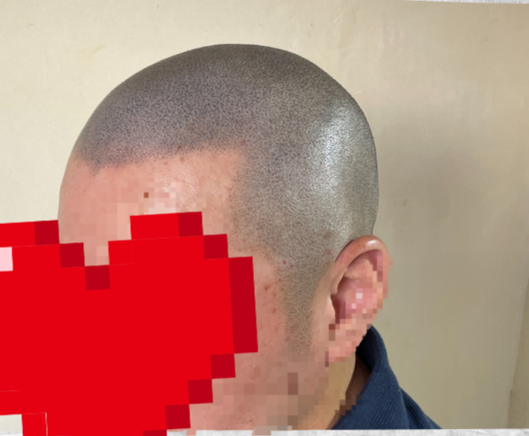 두피문신 후기 입니다... 결과는 괜찮지만...