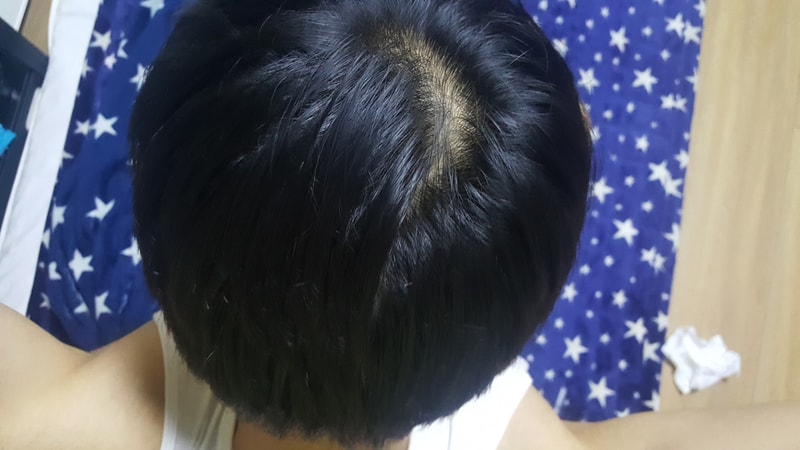 정수리 탈모 시작..두피문신문의!