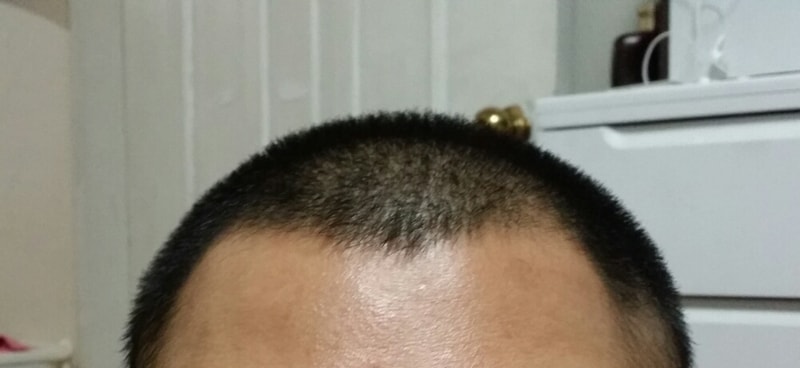 사진) 모발이식밖에없을까요?