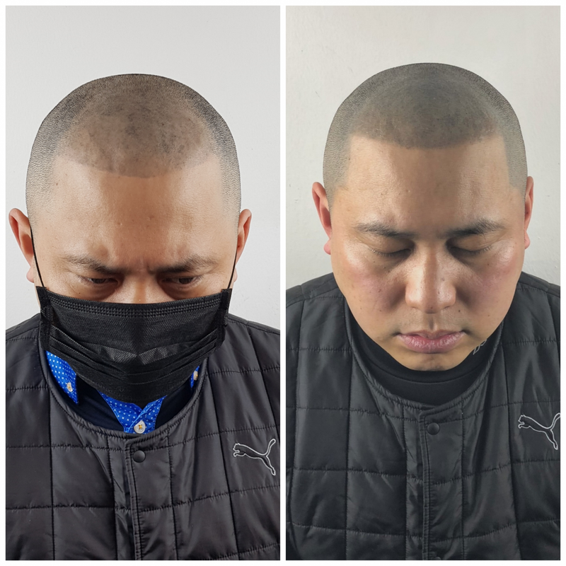 두피 문신 실패 후 3차수정