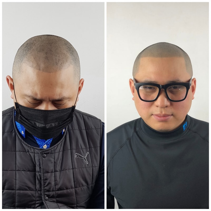 두피 문신 실패 후 4차 수정 드디어 완료 ~^^*