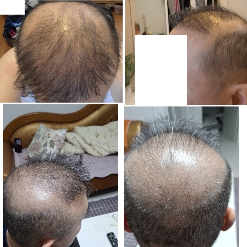 第4次手术釜山OOOSMP头皮纹身