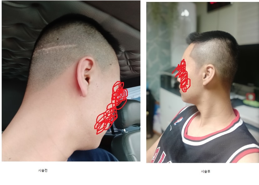 후측부