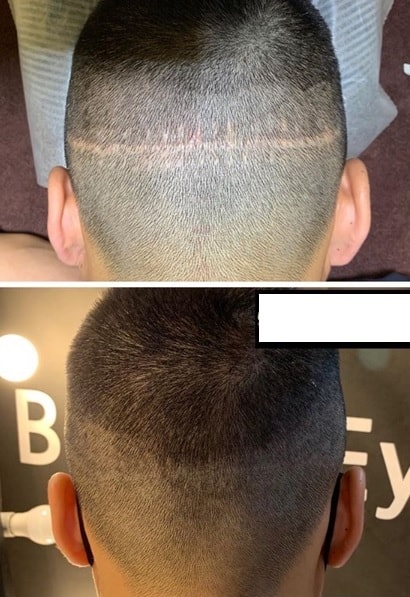 This is a review of the male scalp tattoo SMP. (Laryngeal scar, hairline, M-shaped density)
