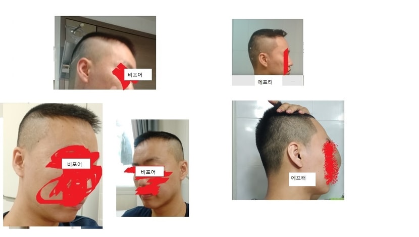 헤어라인