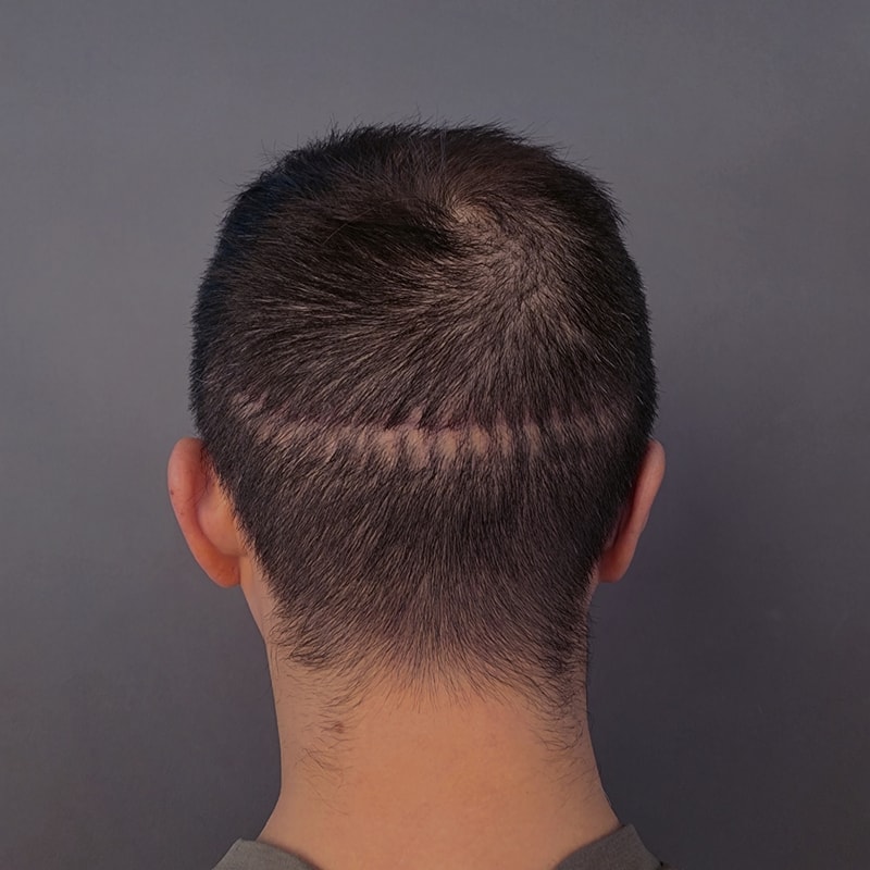 두피문신으로 남자 모발이식 수술흉터 커버 가능한 이유