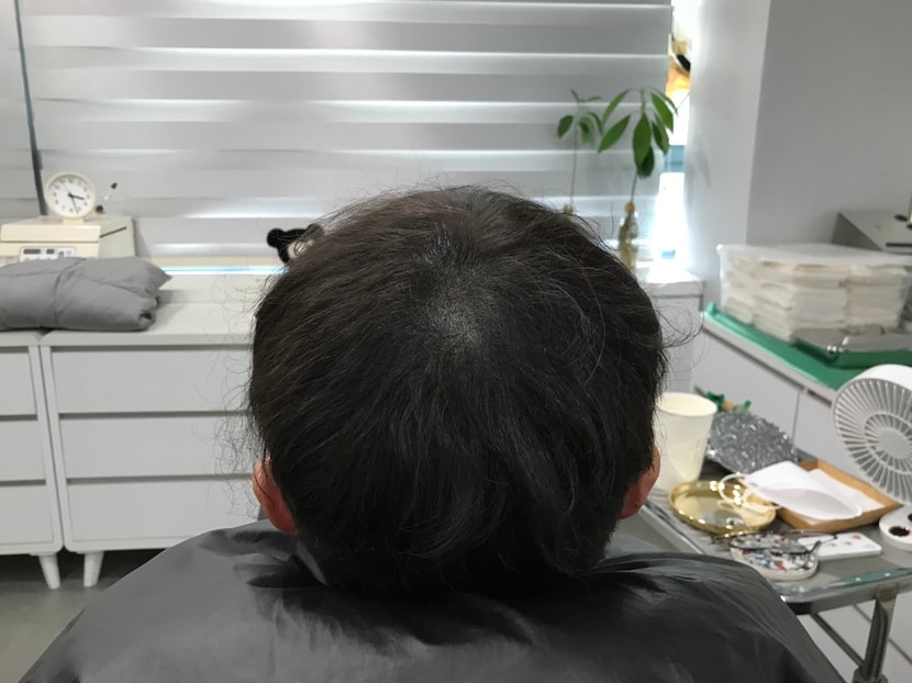 시술후 말린상태
